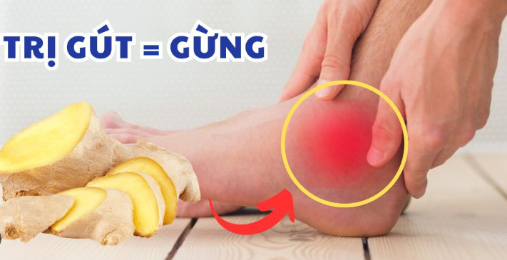 Chữa gout bằng gừng: Top 4 bài thuốc đơn giản nhưng giảm đau cấp tốc nhanh chóng