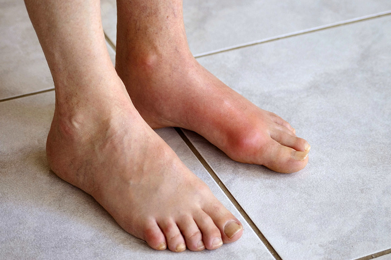 Sưng đau ngón chân cái có phải bệnh gout không?