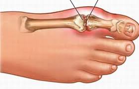 Sưng đau ngón chân cái có phải bệnh gout không?