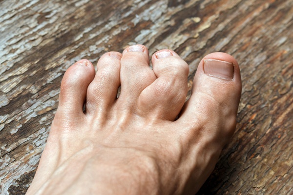 Sưng đau ngón chân cái có phải bệnh gout không?