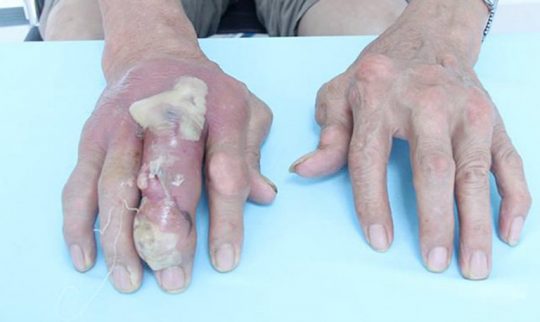 dấu hiệu bệnh gout ở tay