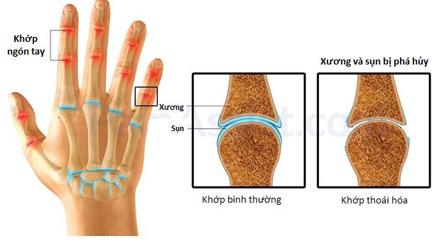 Nổi cục ở đốt ngón tay có phải bị gút không?