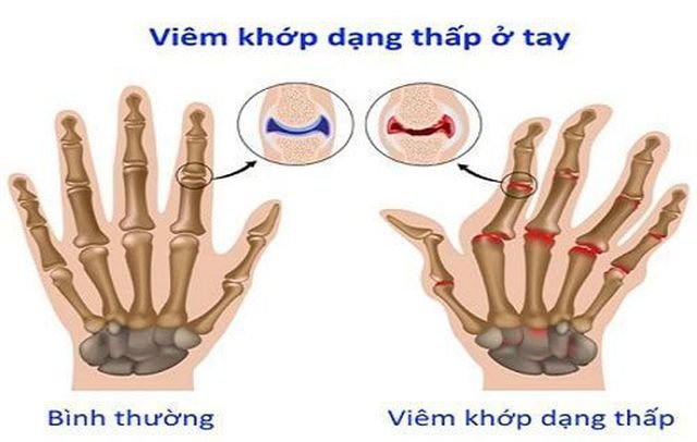 Nổi cục ở đốt ngón tay có phải bị gút không?