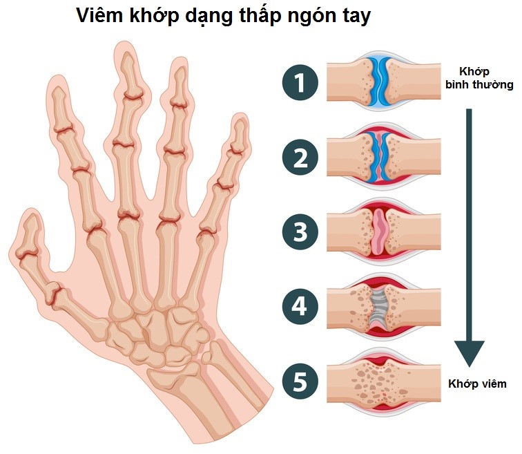 Đau khớp ngón tay trỏ có phải do bệnh gout không?