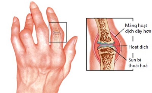 Đau khớp ngón tay trỏ có phải do bệnh gout không?