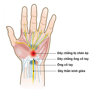 Đau khớp ngón tay trỏ có phải do bệnh gout không?