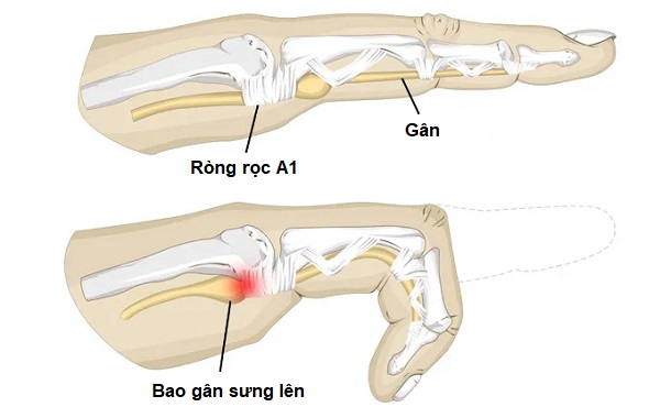 Đau khớp ngón tay trỏ có phải do bệnh gout không?