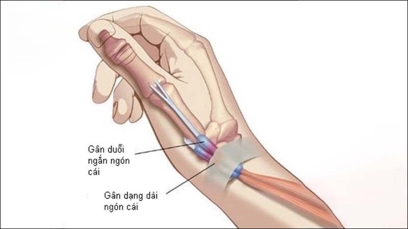 Đau khớp ngón tay trỏ có phải do bệnh gout không?