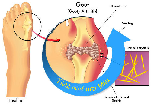 Triệu chứng bệnh gout và giả gout