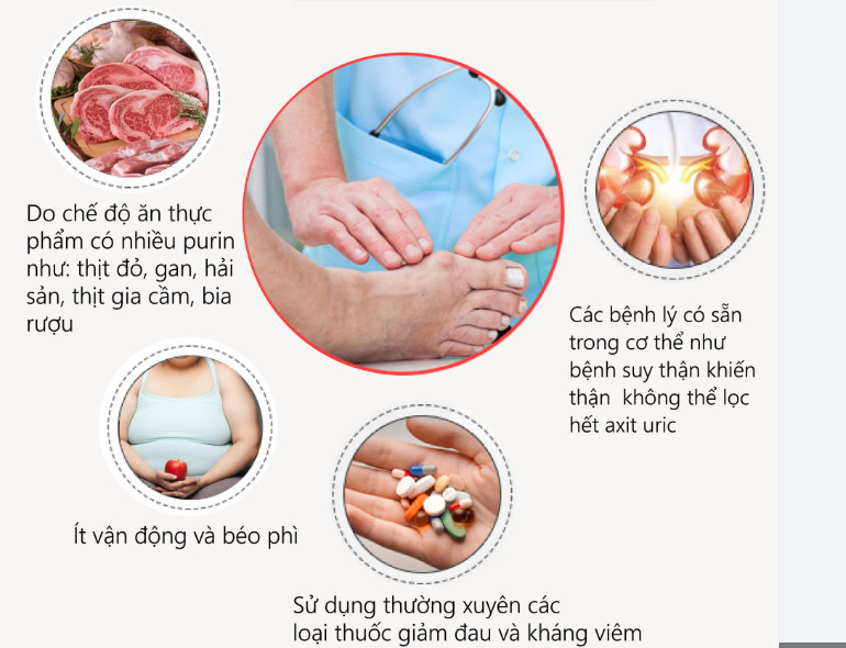 Đau gót chân do bệnh gout phải làm sao?