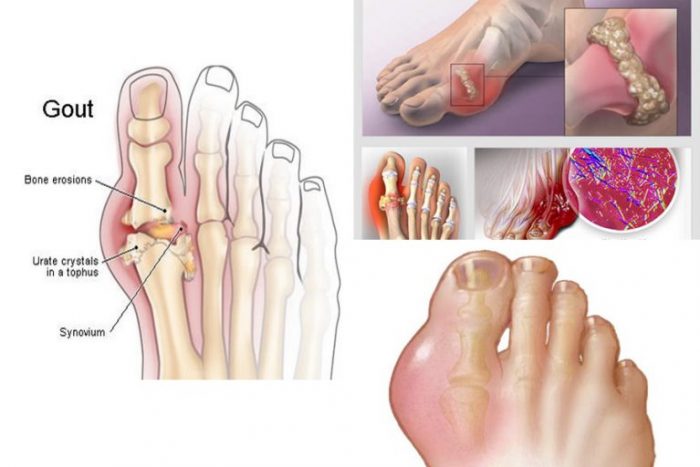 Đau gót chân do bệnh gout phải làm sao?