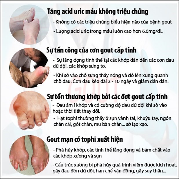 Giai đoạn đầu của bệnh gout