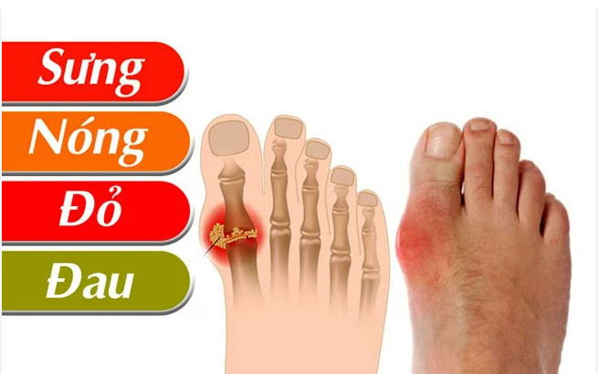 Giai đoạn đầu của bệnh gout