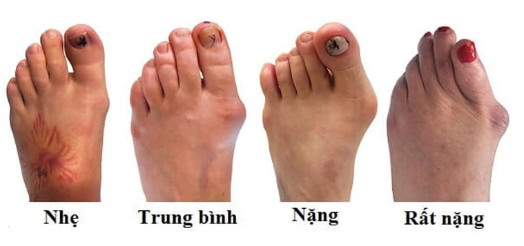 Giai đoạn đầu của bệnh gout: Những dấu hiệu không thể bỏ qua