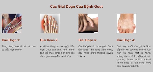 Giai đoạn đầu của bệnh gout