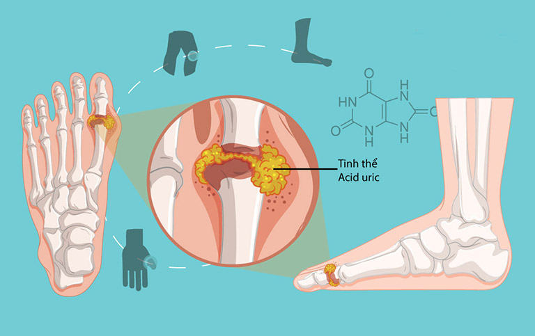 Tăng acid uric máu