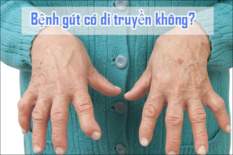 Bệnh gout có di truyền không? Lí giải của bác sĩ chuyên khoa xương khớp