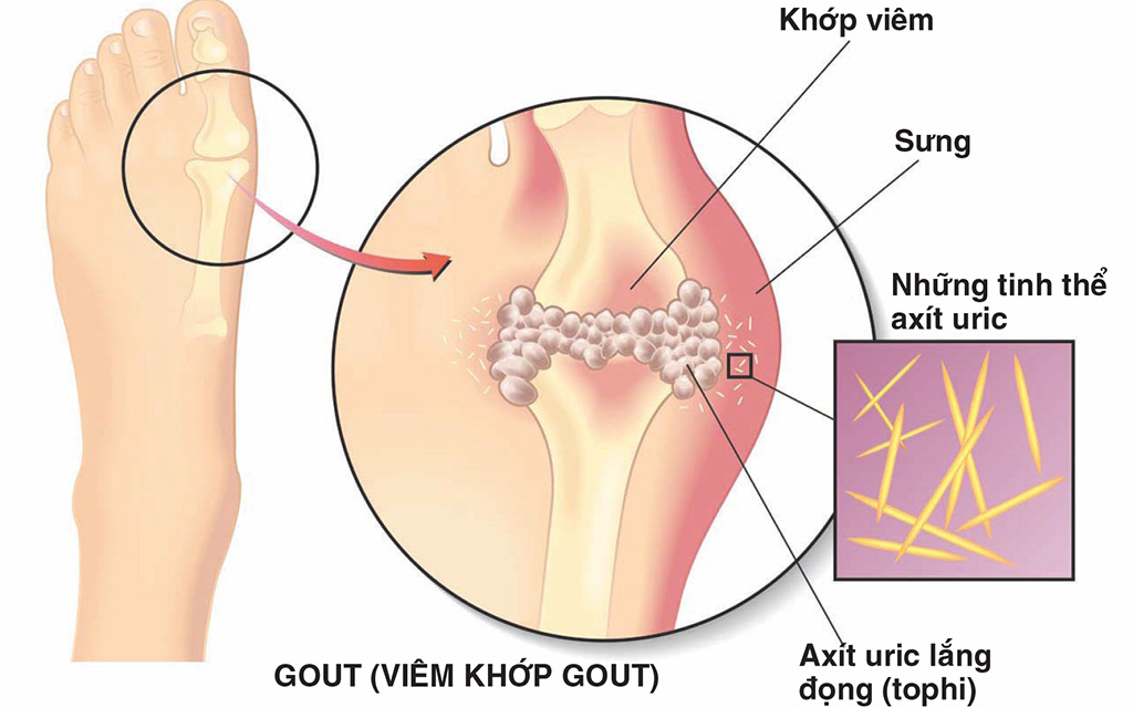 Bệnh gout có di truyền không?