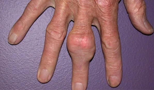 Bệnh gout ở nữ giới có xu hướng tăng cao theo độ tuổi