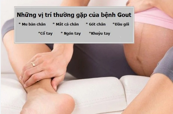 Bị gout khi mang thai