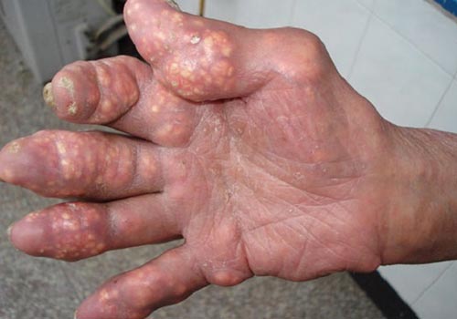 Bệnh gout mãn tính có nguy hiểm không?