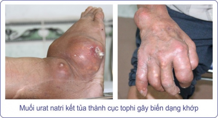 Bệnh gout mãn tính có nguy hiểm không?