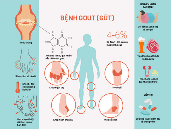 Vì sao ăn kiêng vẫn bị gút?