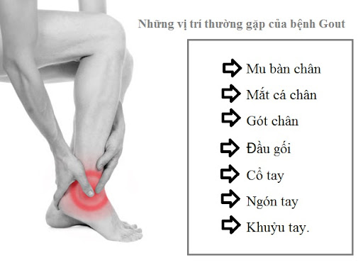 Bệnh gout có gây đau lưng không?