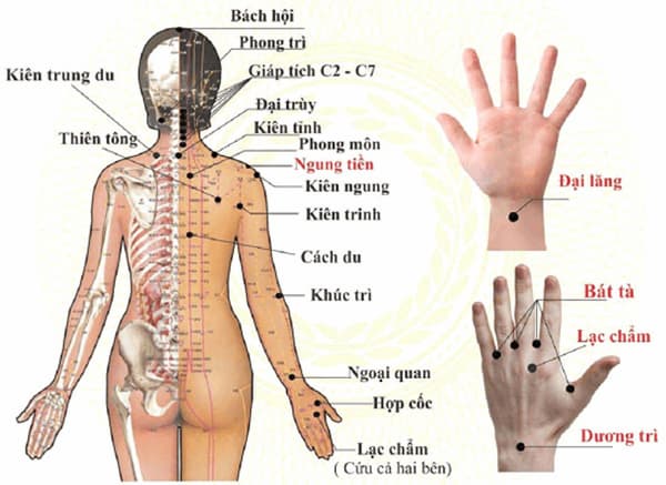 Châm cứu bấm huyệt chữa gout