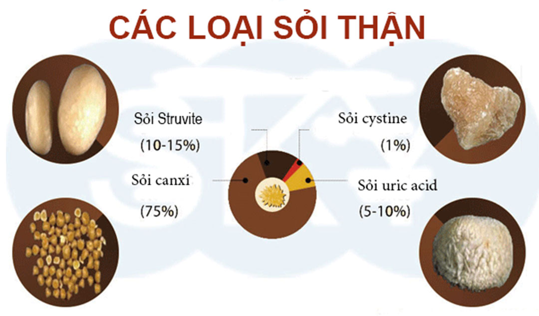 Kiểm soát acid uric máu