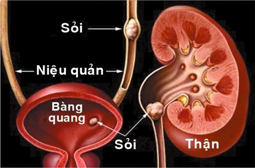 Điều trị biến chứng sỏi thận của bệnh gout: Những điều cần biết