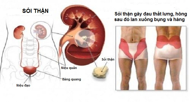 Điều trị biến chứng sỏi thận của bệnh gout