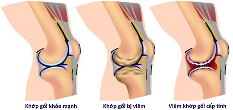 Đau đầu gối là bị gì? 