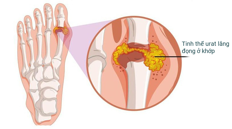 Béo phì – thừa cân gây nên bệnh gout