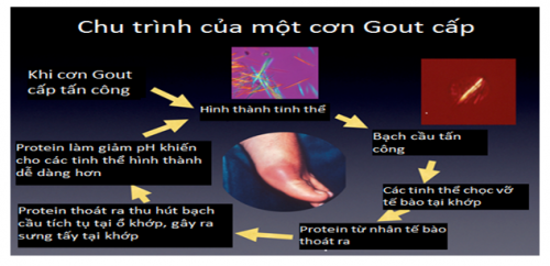 Độ tuổi nào dễ mắc gout