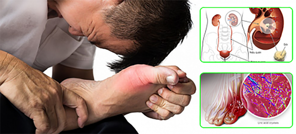 Độ tuổi nào dễ mắc gout