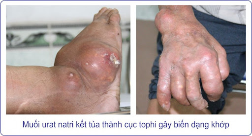 Mổ u cục gút 